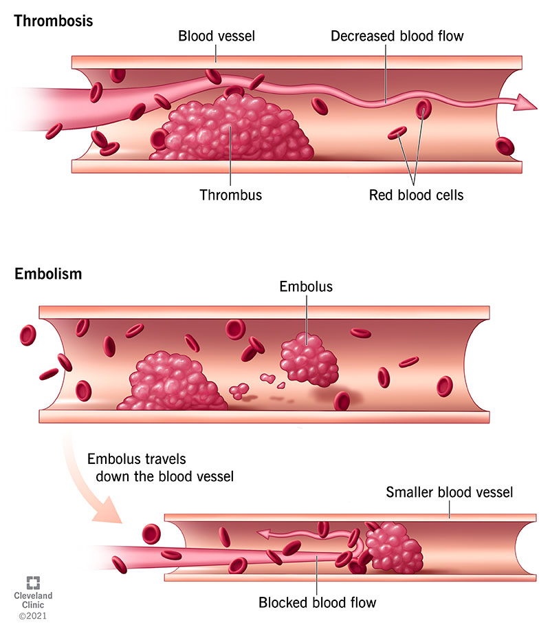 arterial thrombosis vs venous thrombosis