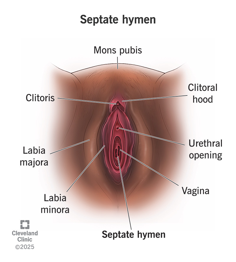 Underside view of external female genitalia showing a septate hymen in the vaginal opening
