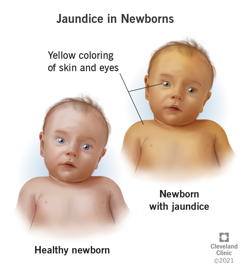 Jaundice in newborns is the yellow coloring of an infant’s skin and eyes. Under their tongue may look yellow too.