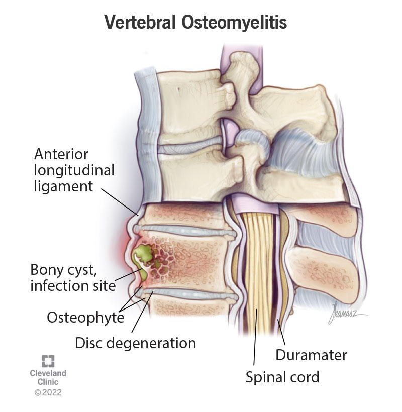 Your spine, which includes anterior and posterior longitudinal ligaments, the spinal cord, the arachnoid and dura matter, can become infected (vertebral osteomyelitis).