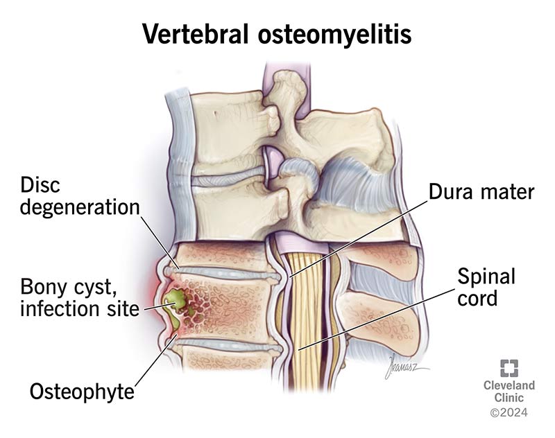 osteomyelitis in the lower back