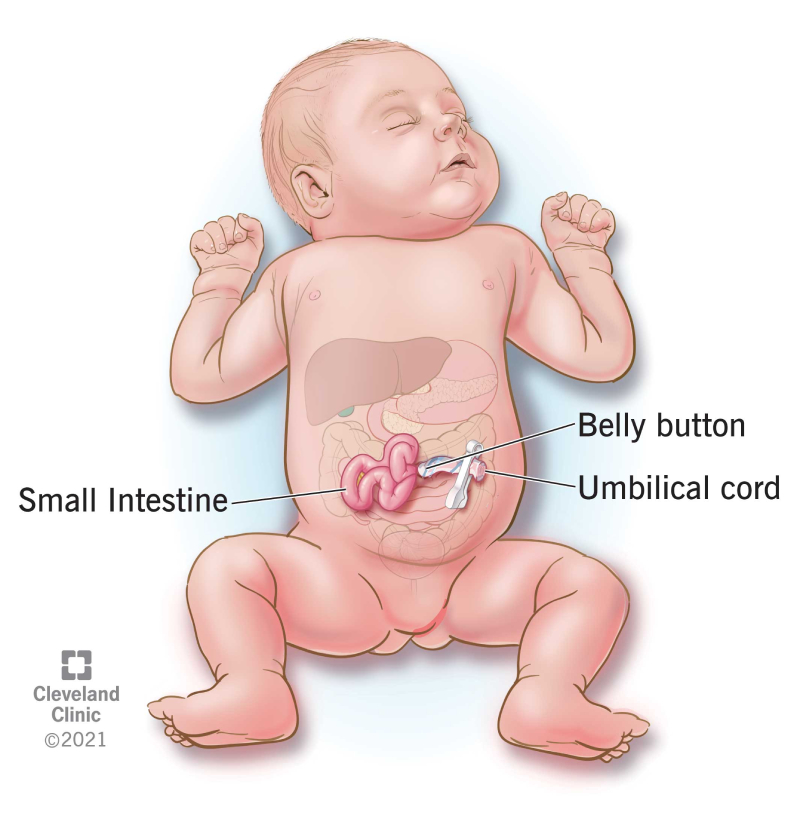 gastroschisis in baby