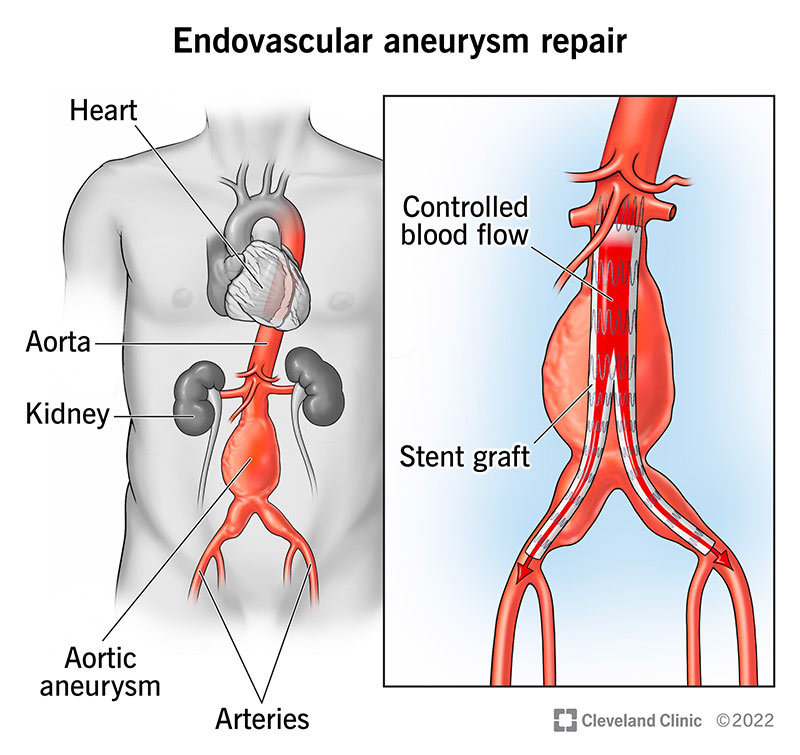 In endovascular aneurysm repair (EVAR), stents are placed to control the flow of blood in your aorta.