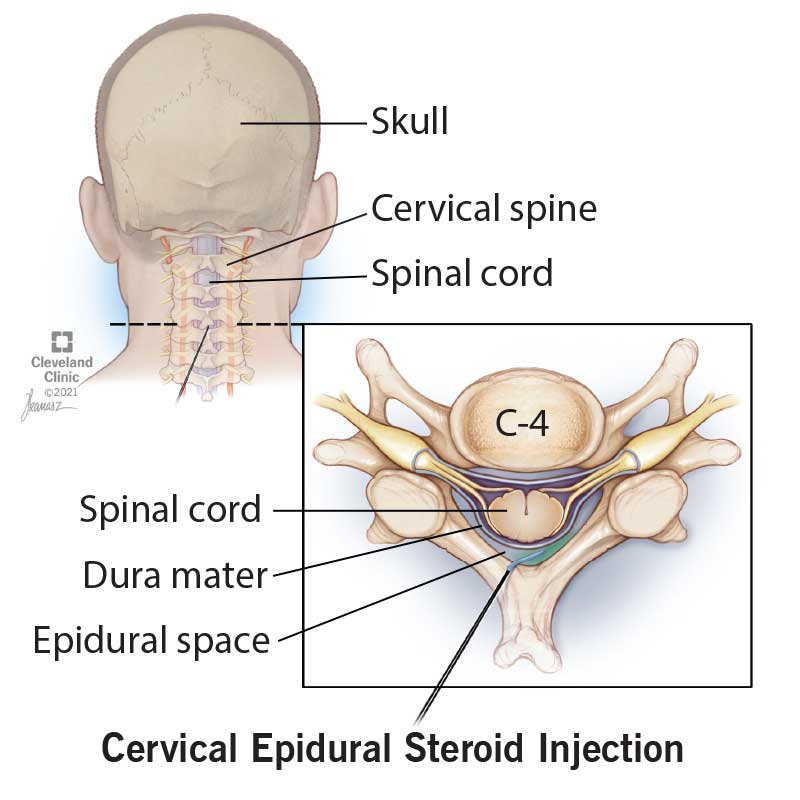 Cervical Thoracic Placement Example 