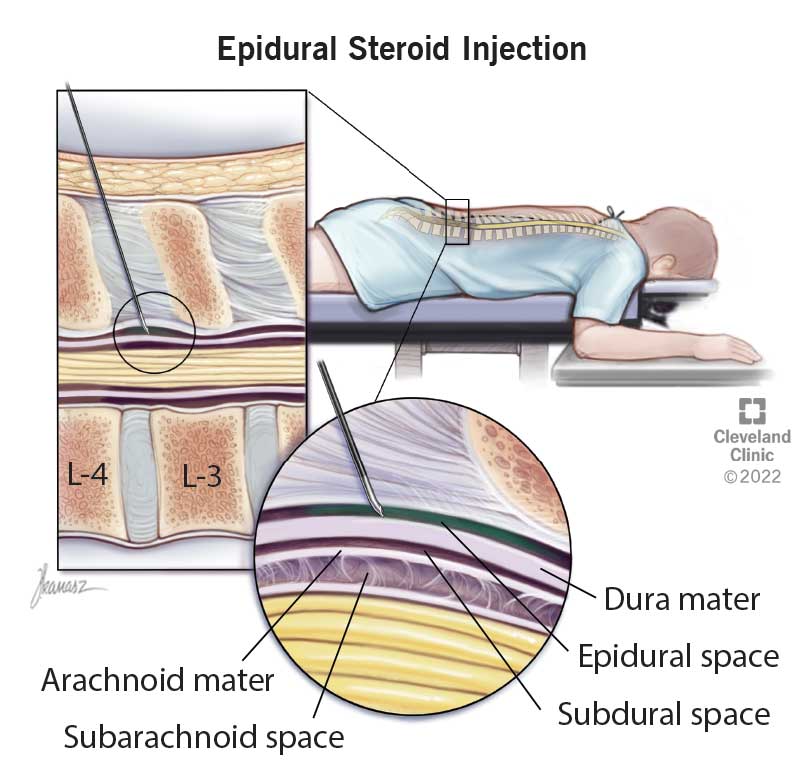 Epidural Steroid Injection (ESI): What It Is, Benefits, Risks & Results