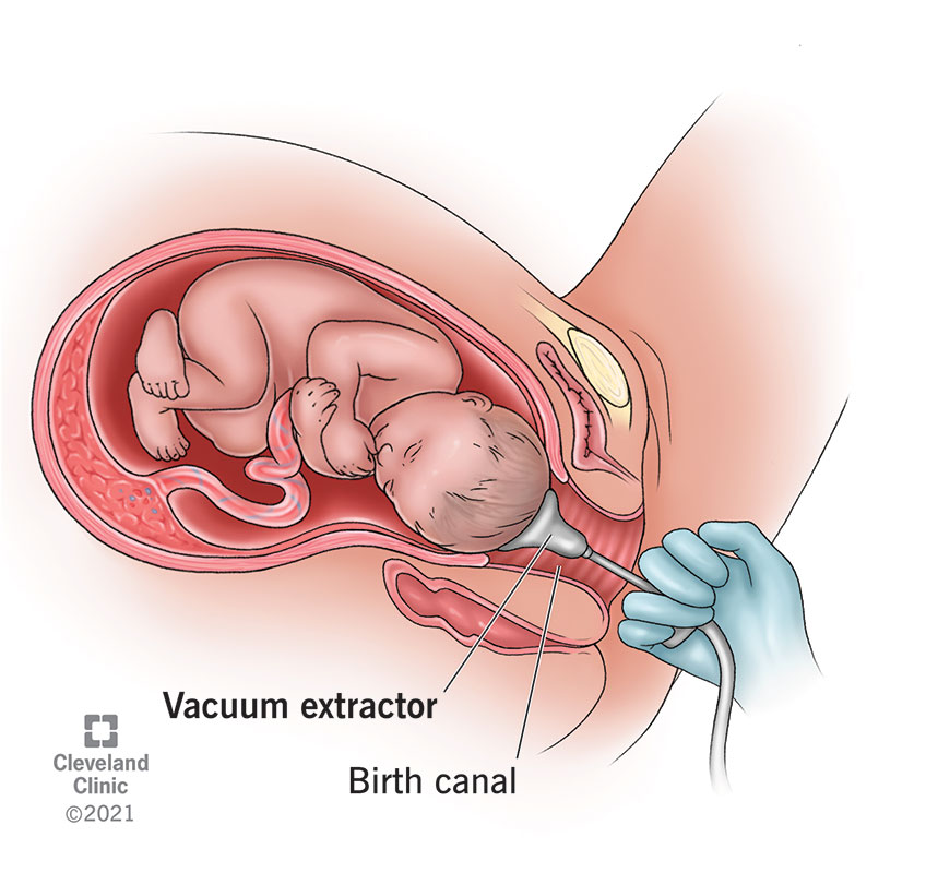 The suction cup of the vacuum extractor attaches to your baby’s head in the birth canal, while the pump applies traction.