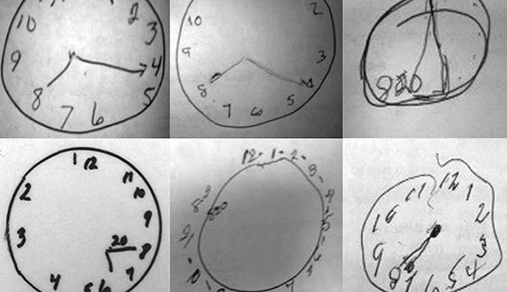 A clock-drawing screening test for cognitive impairment involves drawing a circle and adding clock numbers and clock hands to show a specific time.