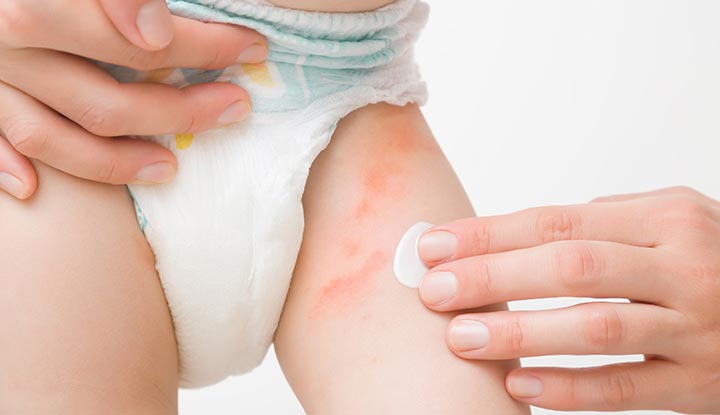 Yeast Diaper Rash (Candida Diaper Dermatitis): Symptoms, Causes, Treatments