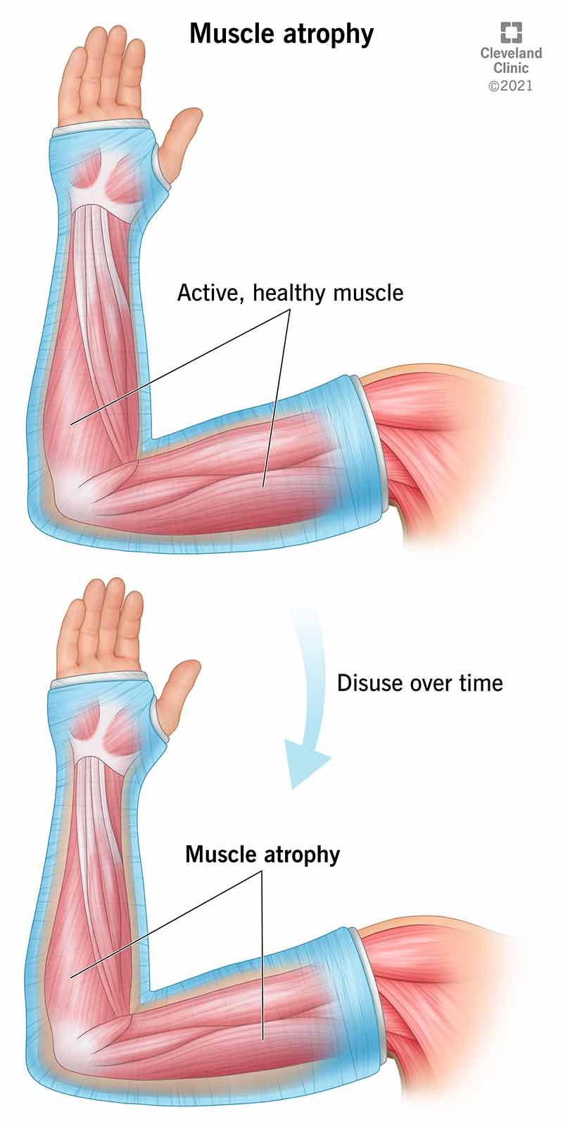 muscle atrophy