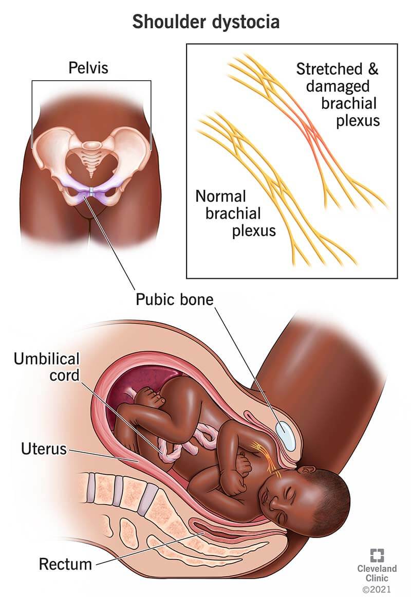 Your baby’s brachial plexus nerves can be damaged due to shoulder dystocia during childbirth
