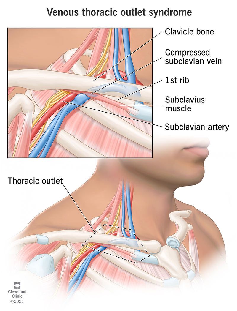 Illustration showing the compression of veins and arteries between the collar bone and first rib causing venous thoracic outlet syndrome.