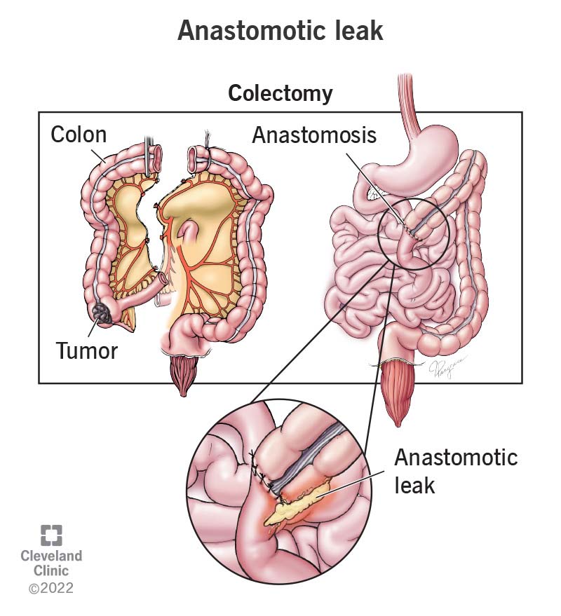 An anastomotic leak occurs when a surgical anastomosis fails.