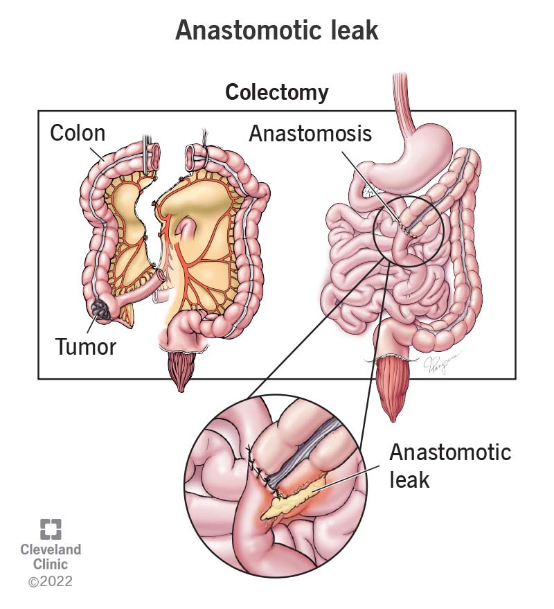 What Causes Anastomotic Stricture