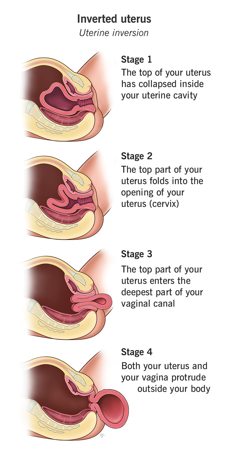 Different degrees and severities of inverted uterus