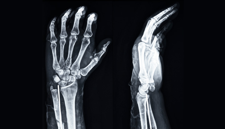 broken hand bones xray