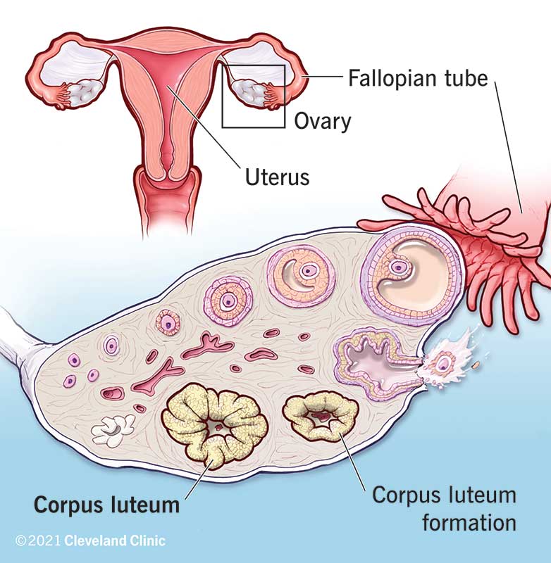 Development of a corpus luteum cyst during the ovarian cycle.