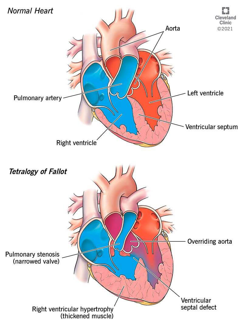 Illustration showing four heart defects that cause tetralogy of Fallot.