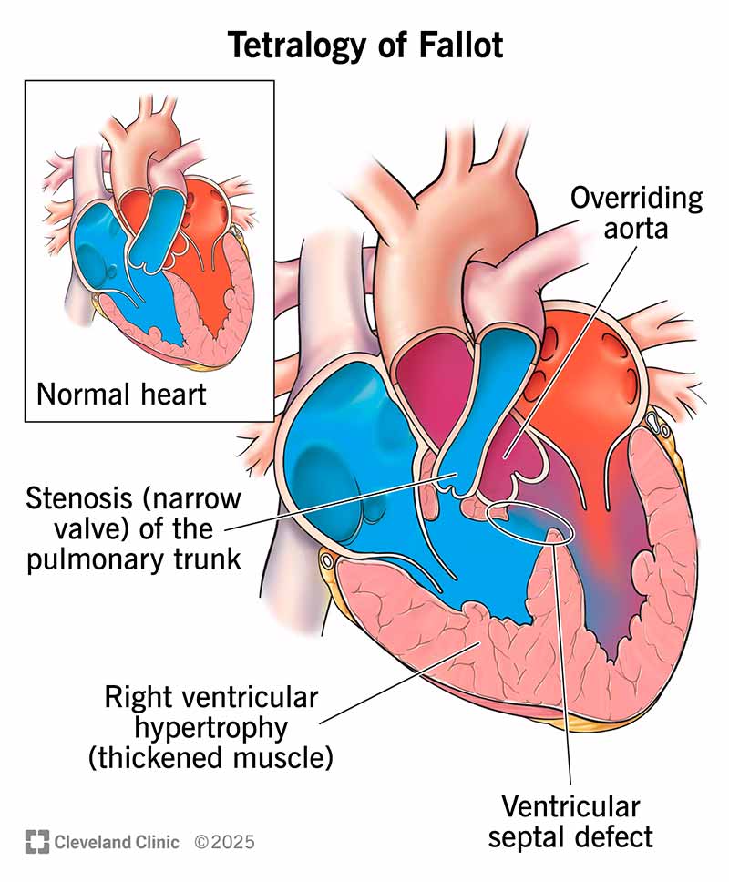Tetralogy Of Fallot ToF Symptoms Causes Treatment
