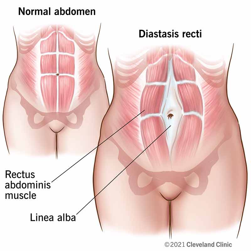 Normal abdomen compared to an abdomen with diastasis recti.