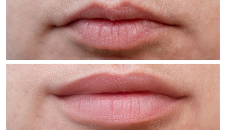 Before and After Lip Flip procedure
