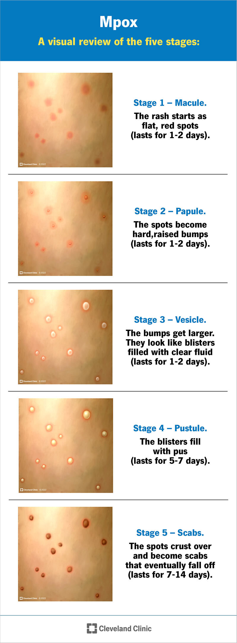 Mpox rash starts as flat, red spots that become raised, fill with fluid and pus, then crust and fall off.