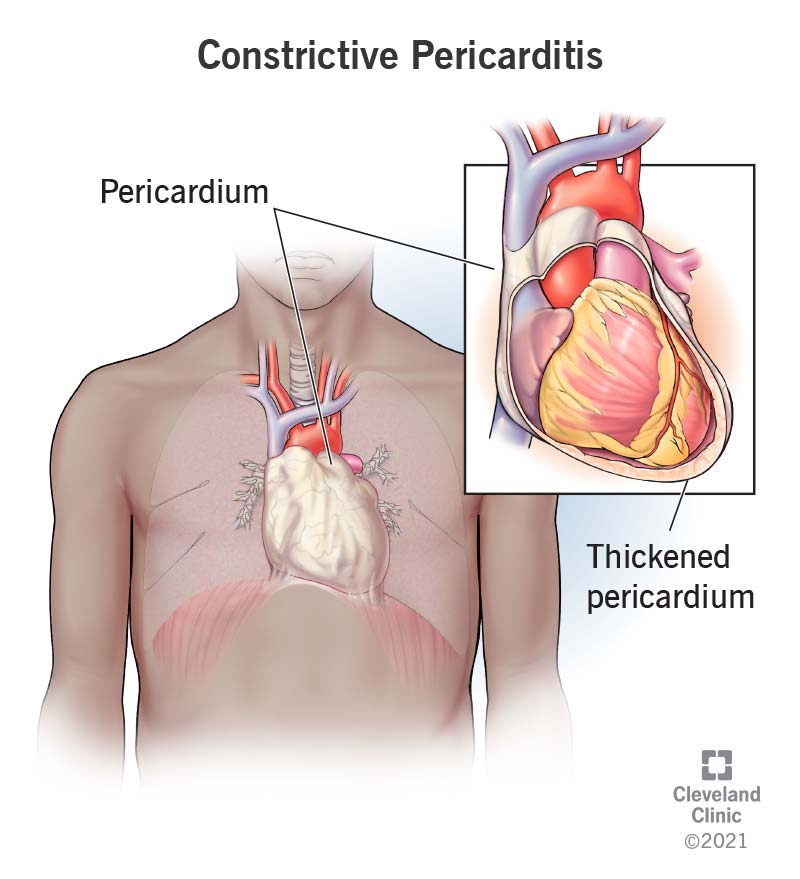 Constrictive pericarditis causes the pericardium to become thickened and scarred.