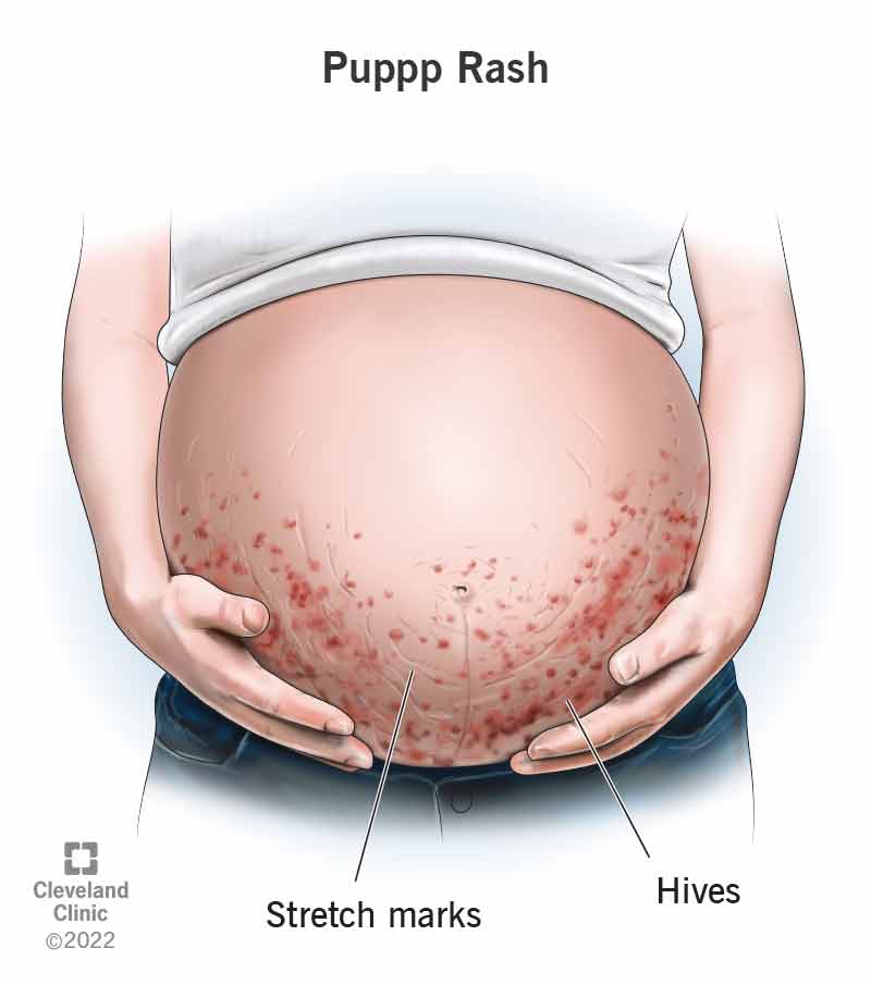 7 types of pregnancy rash: Symptoms and what they look like