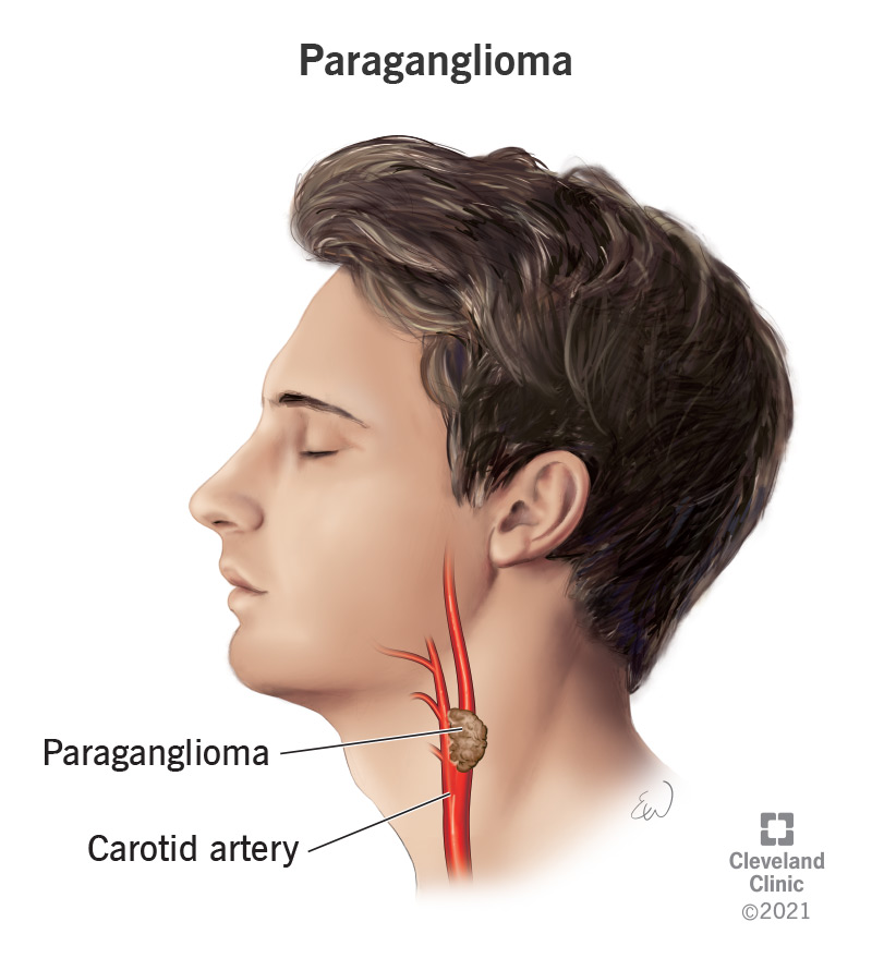 Paraganglioma of the head and neck