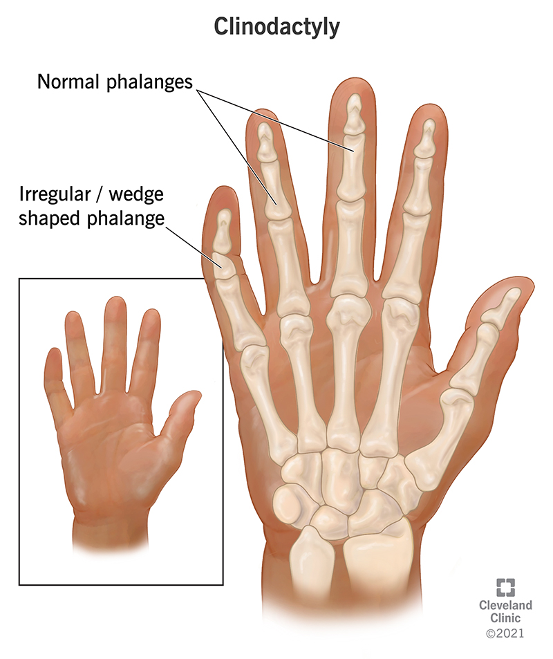 Clinodactyly causes one of your fingers to curve between the two knuckles on your finger. The curve bends toward the other fingers on your hand. It’s common to have clinodactyly on your fifth finger or your pinky finger. This condition occurs because your finger bone forms a wedge or a triangle instead of a rectangle.