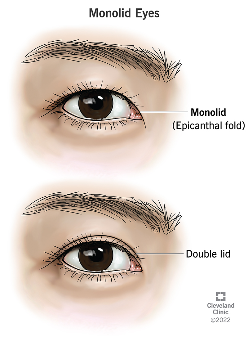 Monolid eyes (epicanthal folds) don’t have creases between the eyelashes and eyebrows. Double lids have these creases.
