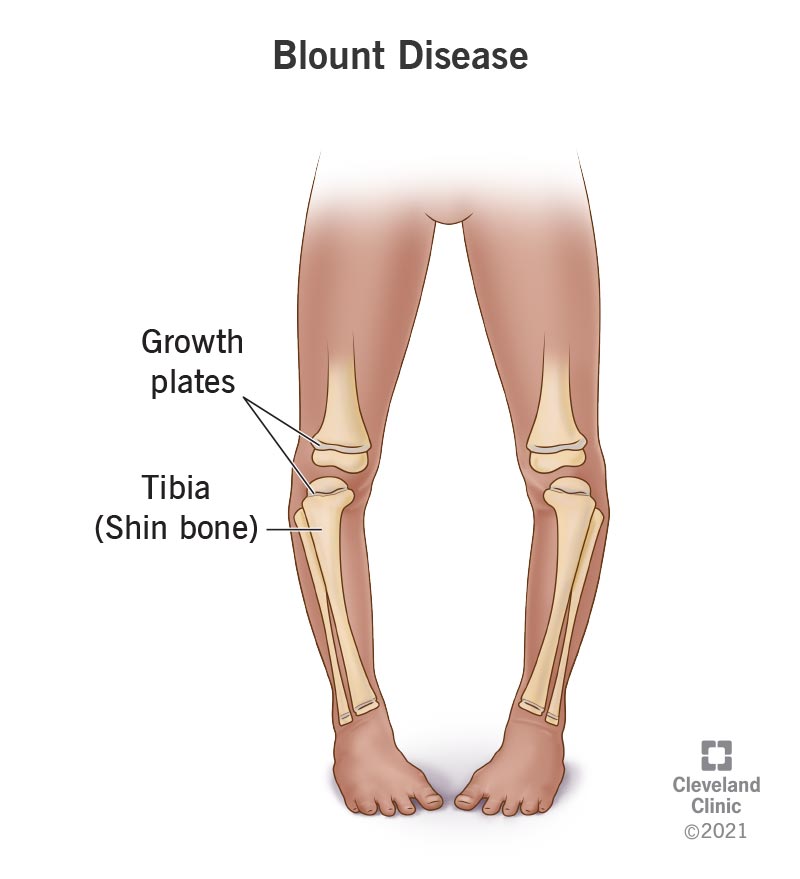 Blount’s disease affects how the growth plates in the shin bone (tibia) grow in children. Blount’s disease causes a bow or bend in the leg below the knee that resembles the curve in the letter “C.”