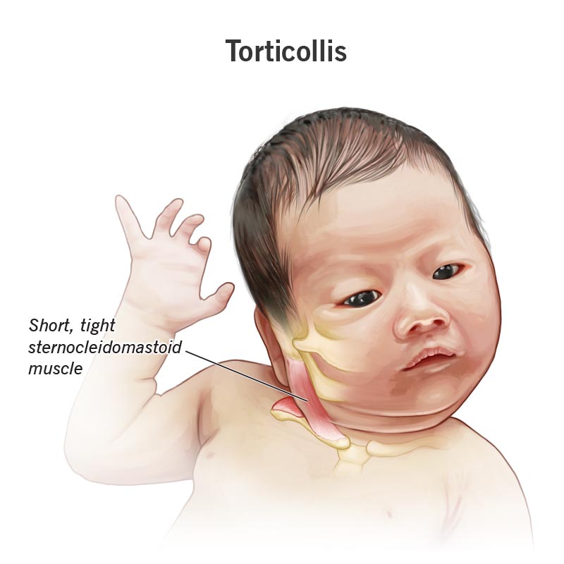 Los músculos esternocleidomastoideos (SCM, por sus siglas en inglés) cortos y tensos pueden causar tortícolis, una afección en la que la cabeza de su bebé se tuerce y se inclina hacia un lado.