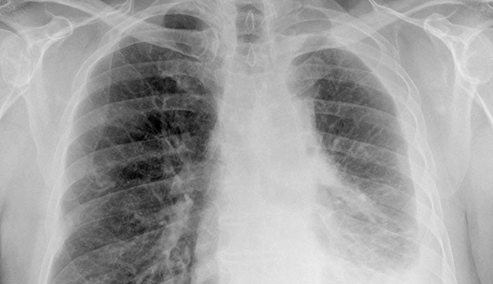 Chest X-ray showing loss of lung volume on person's left side from mesothelioma.