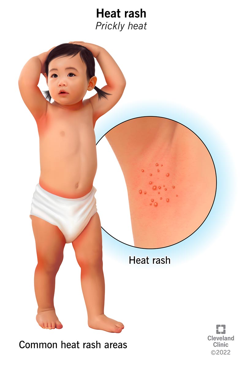 A heat rash is a group of tiny pimples in areas of your body that don’t get enough airflow, especially near the underarms or diaper region among infants. 