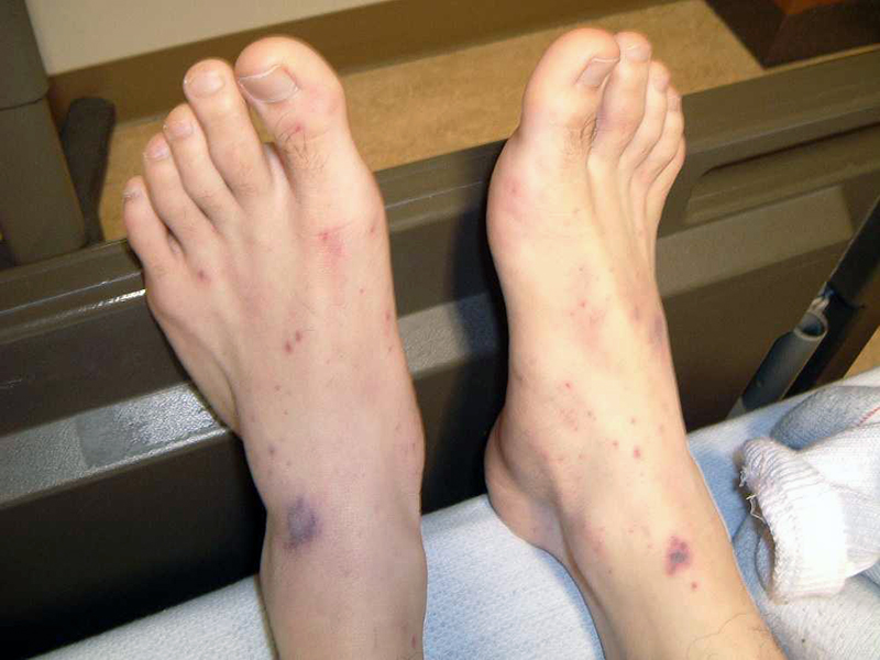 Hands and feet are covered with a petechial rash which looks like spots of blood from meningococcal disease.