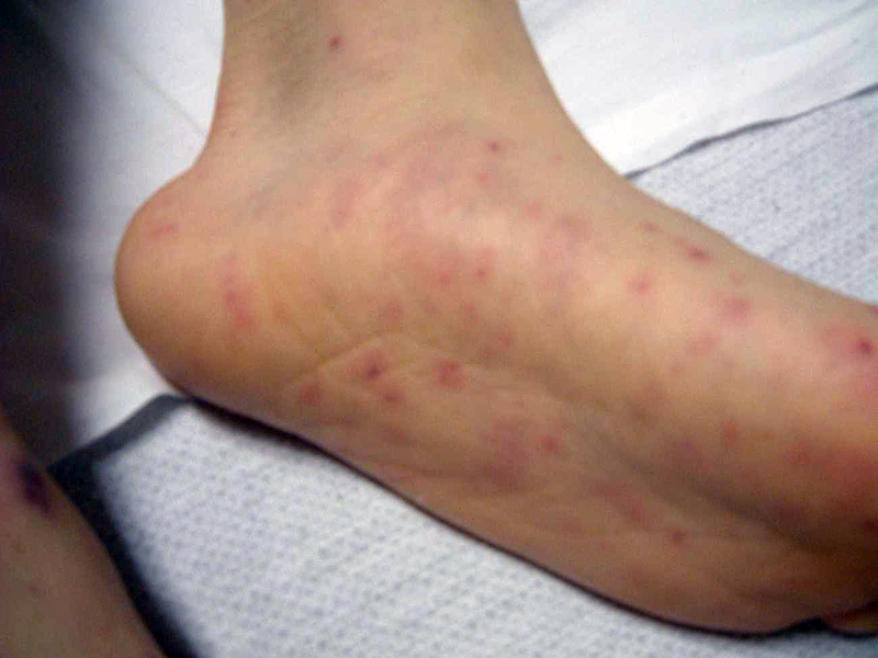 Hands and feet are covered with a petechial rash which looks like spots of blood from meningococcal disease.