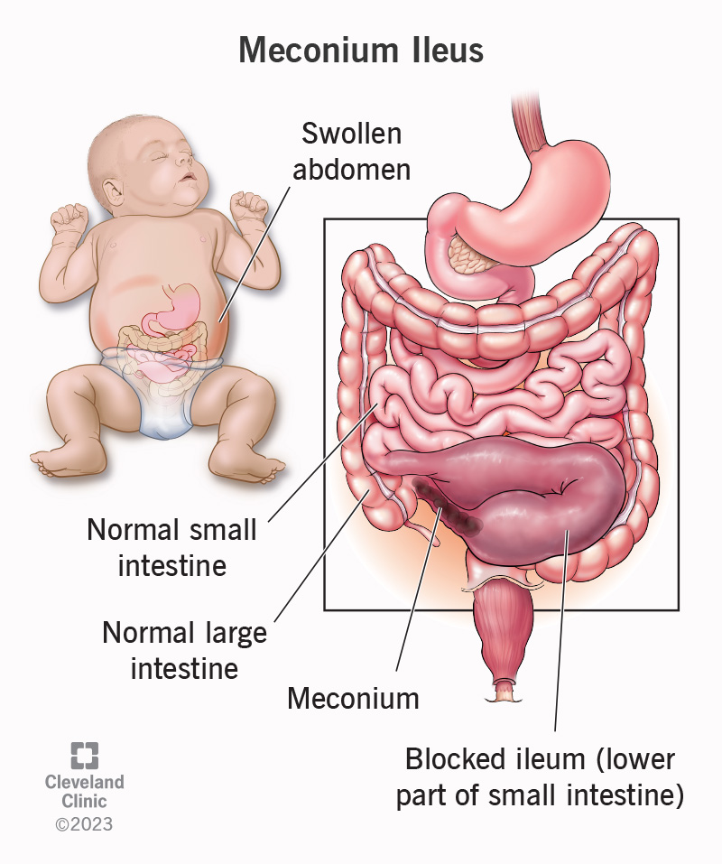If your baby’s first poop (meconium) is abnormally thick or tar-like, it can block the last part of their small intestine (the ileum).