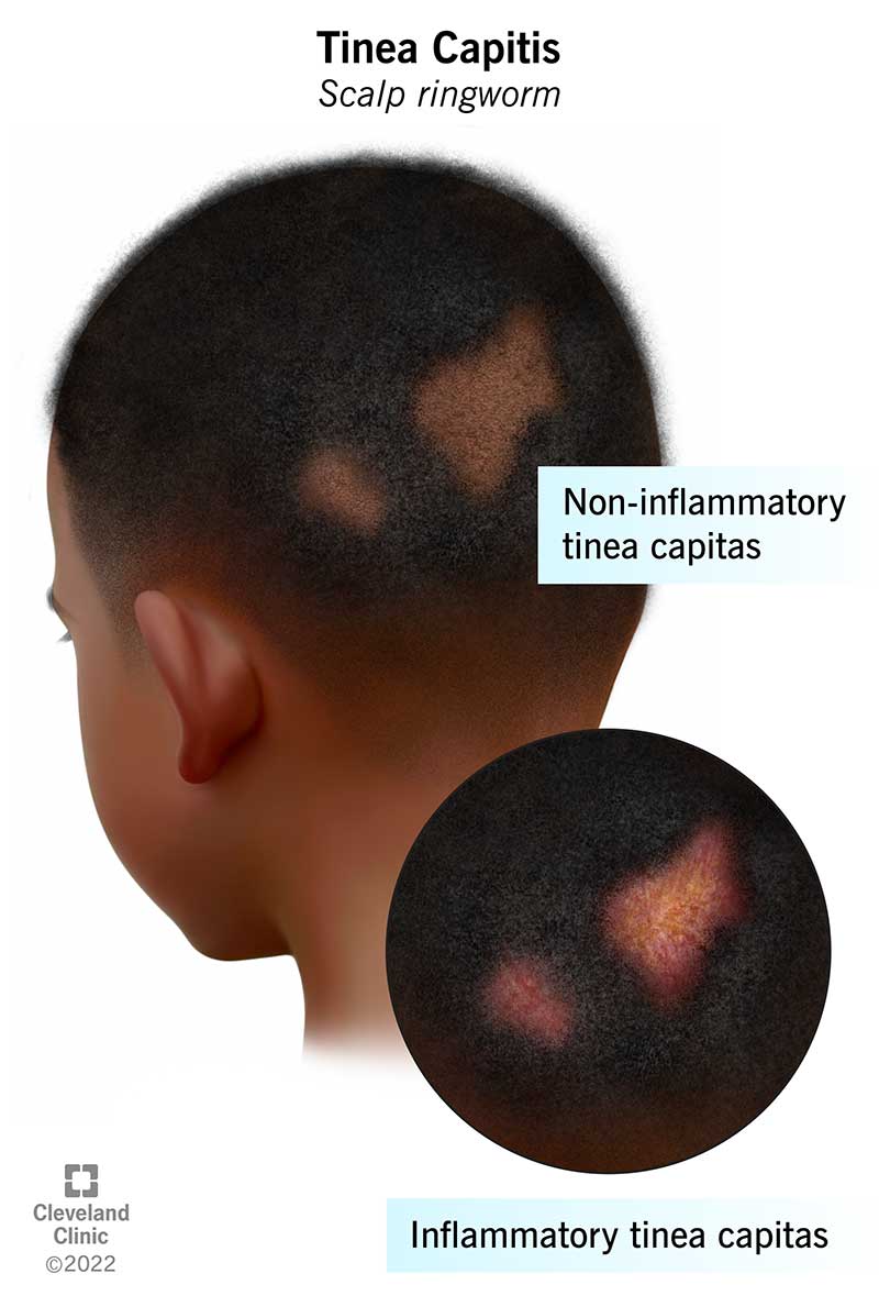 ringworm in humans on head