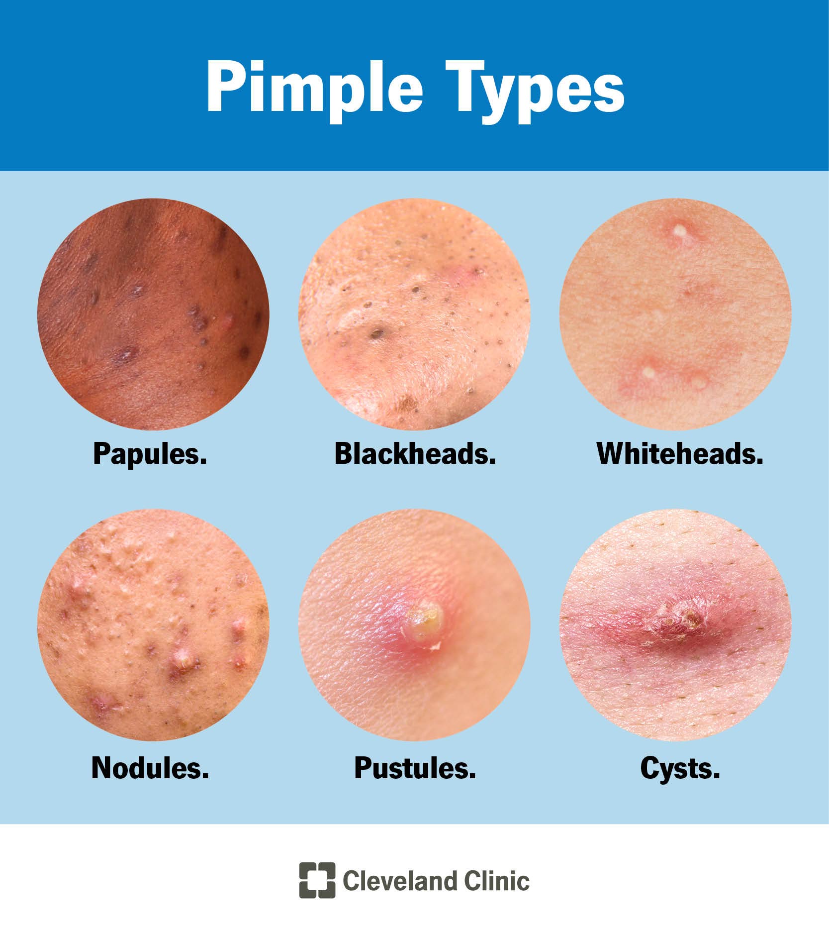 Six different types of pimples, including papules, blackheads, whiteheads, nodules, pustules and cysts.