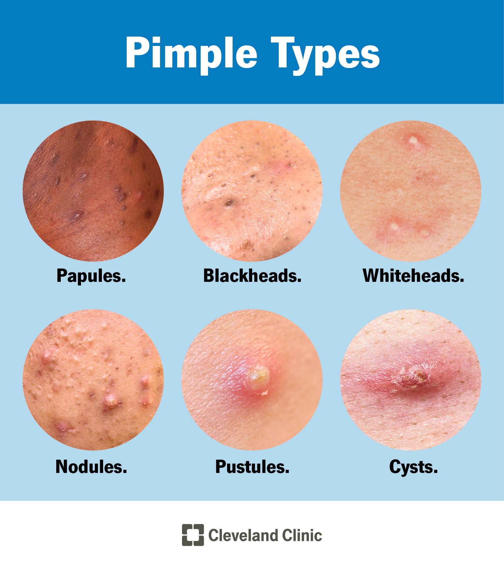 is-popping-pimples-really-that-bad-for-your-skin-2022