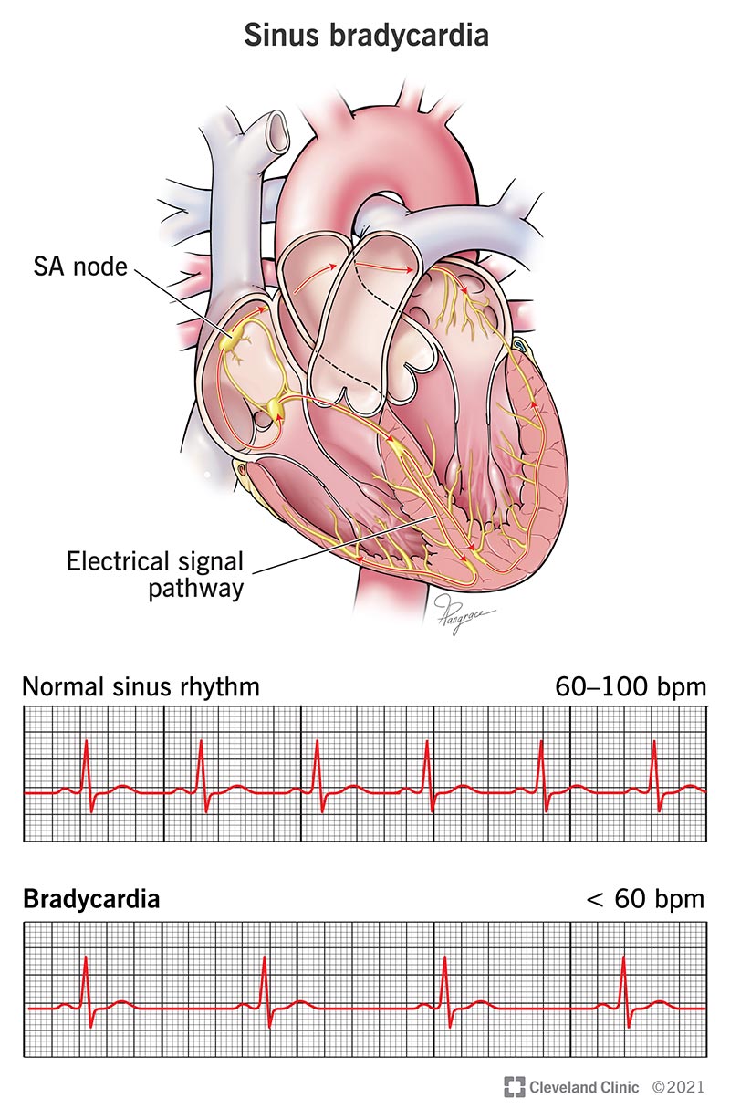 EKG and illustration of sinus bradycardia.