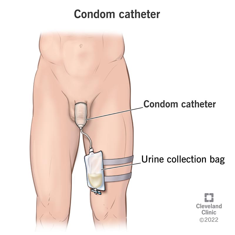 A condom catheter is applied over the penis like a condom and pushes urine through tubing to a collection bag attached at the thigh.