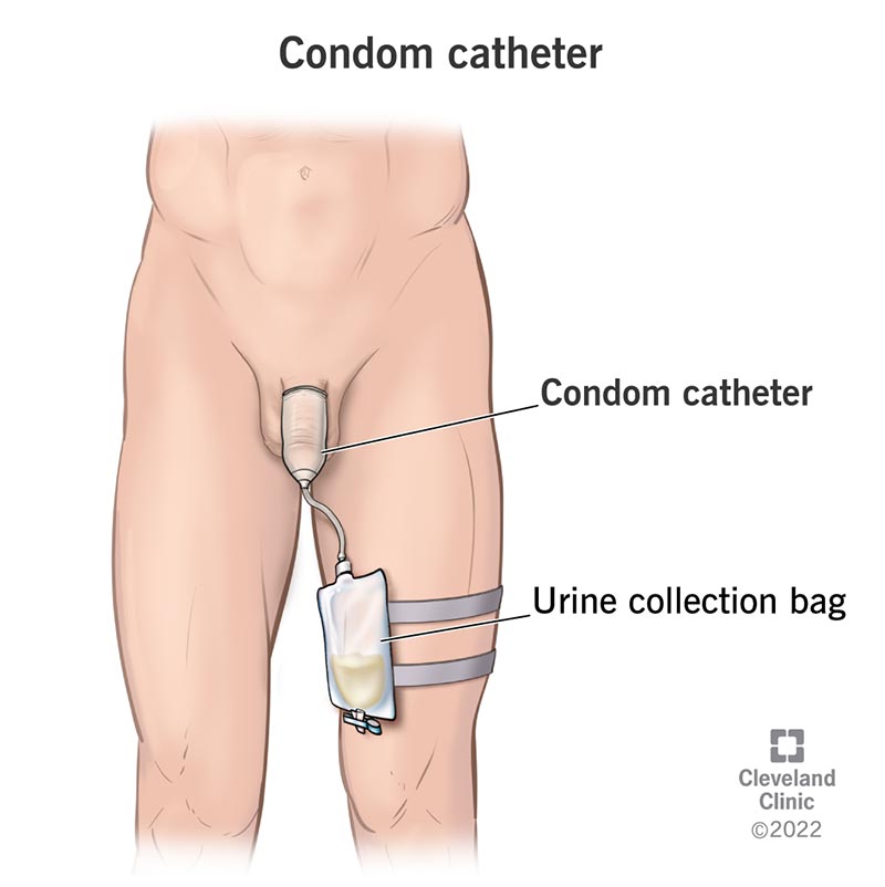 Condom Catheter For Incontinence Application Use Care