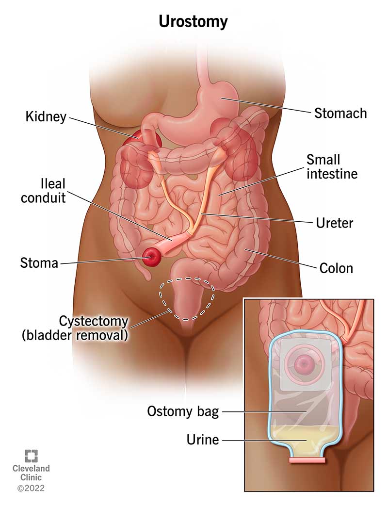 If your urinary bladder is removed and you have a urostomy, urine goes from your kidneys to ureters, an ileal conduit and then a stoma to an ostomy bag.