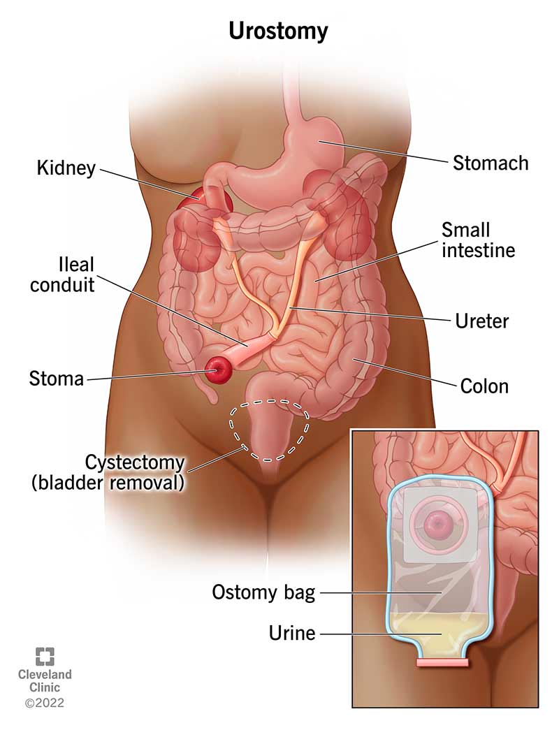 Post-Op Urinary Retention and Why You Can't Pee After Surgery