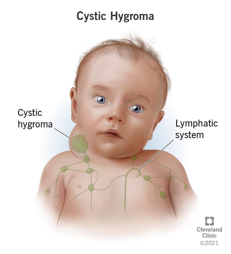 A cystic hygroma is a fluid-filled bump that forms on a baby’s neck caused by a blockage in the lymphatic system pathways.