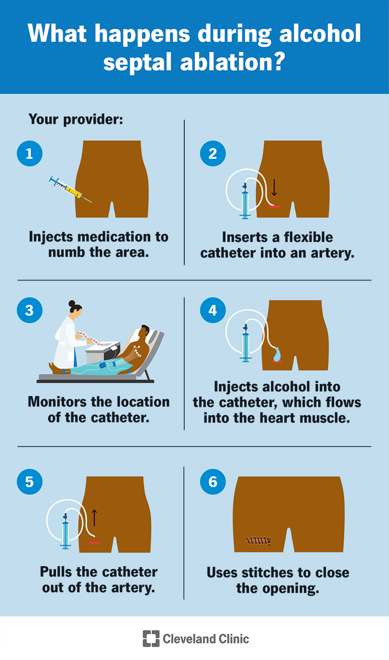 A step-by-step guide to what happens during alcohol septal ablation.