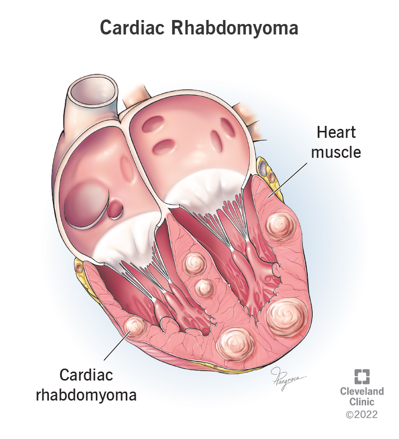 Illustration showing a cluster of cardiac rhabdomyomas in the heart muscle.