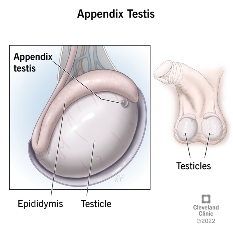 Appendix testis is a glob of tissue on the testis.