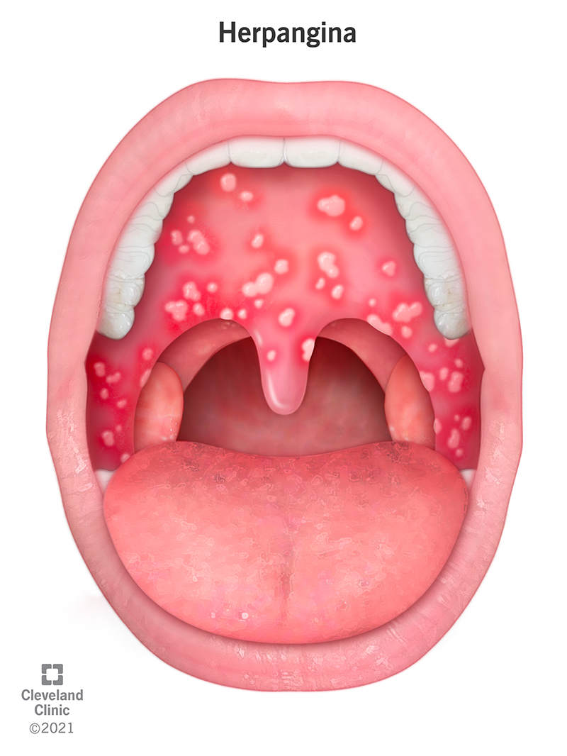 Herpangina is a virus that causes small blisters to form inside of a child’s mouth. These blisters look like white bumps or pimples that appear on the roof of your child’s mouth, on the inside of their cheeks and in their throat.
